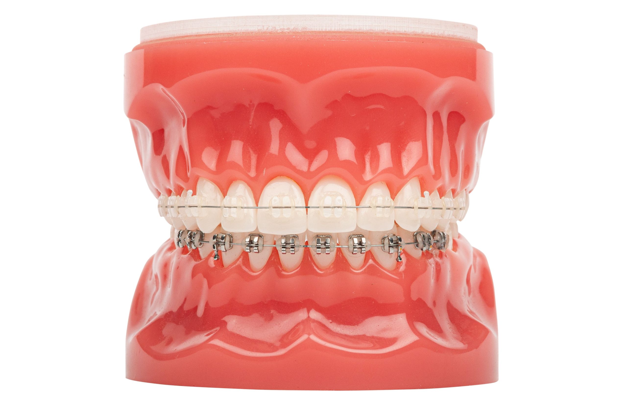 Ceramic Braces - Billericay Orthodontics