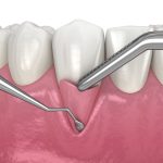 Choosing the Right Gum Grafting Procedure PIC min scaled 1