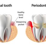 Compare non surgical to surgical gum disease tx v1 min scaled 1