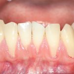 Receded gums in lower incisors