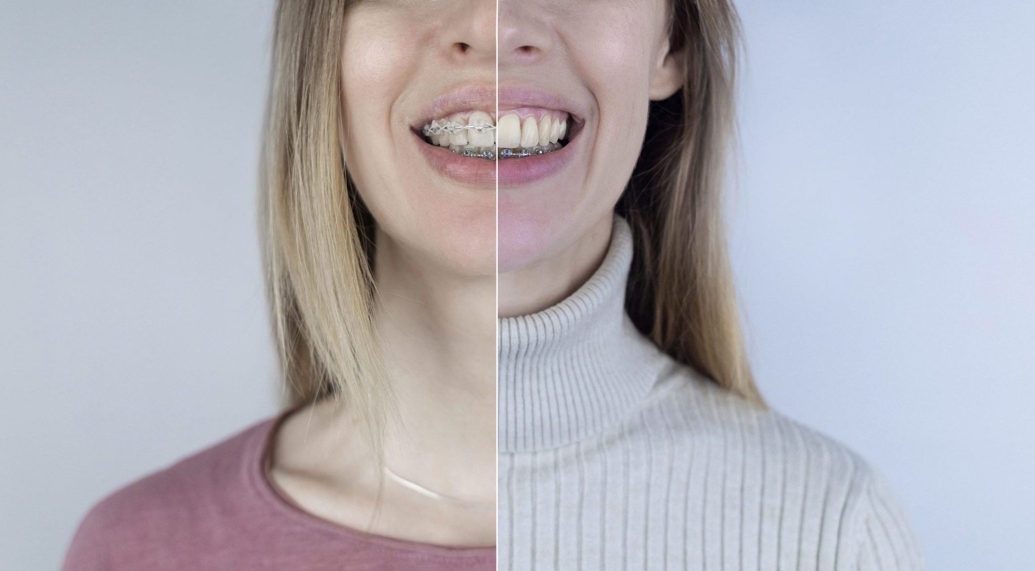 Lingual Braces vs Clear Aligners Which is Option Better London