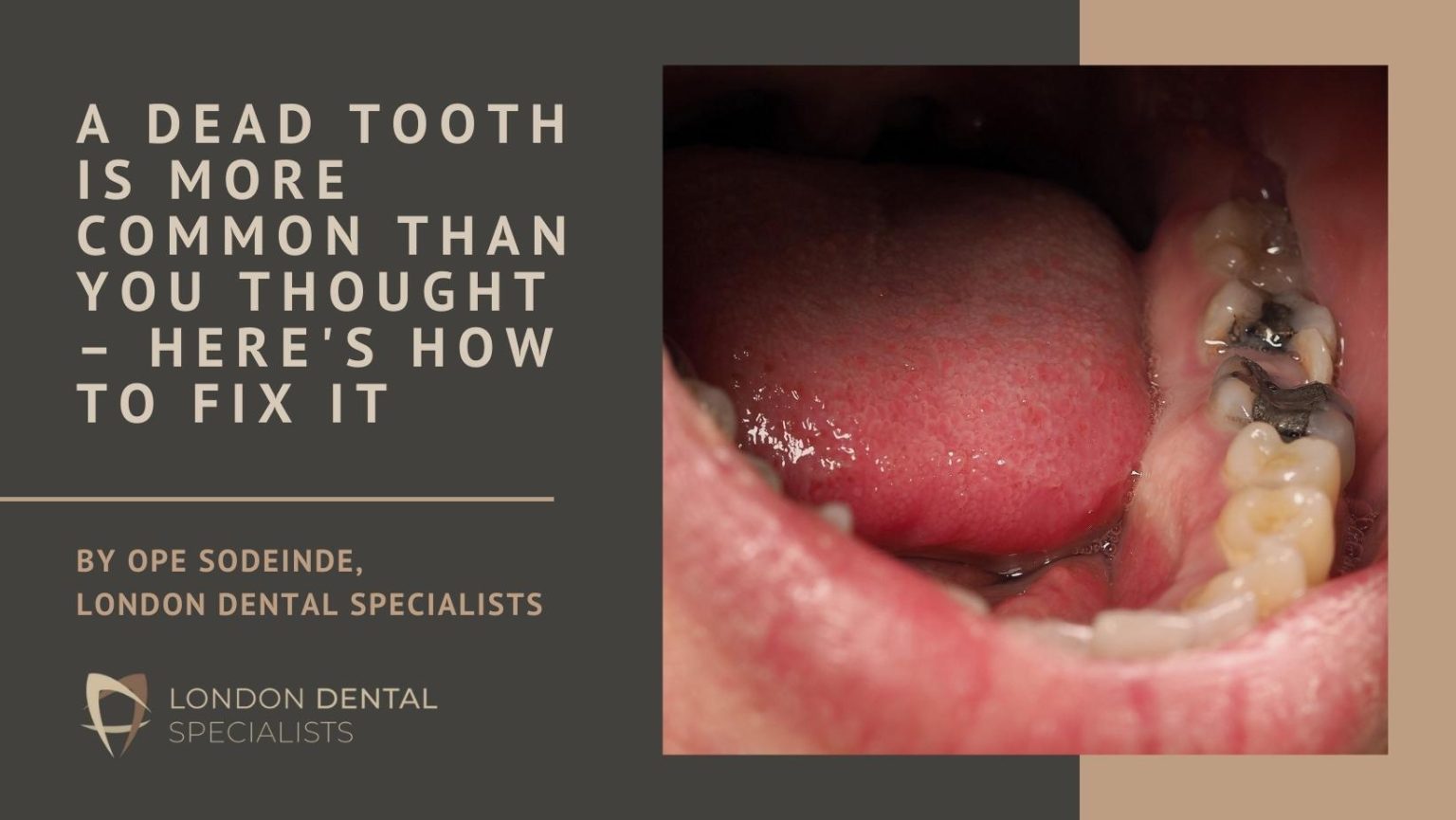 Understanding and Treating a Dead Tooth: Expert Insights