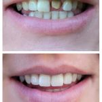 before and after pictures of problematic porcelain veneers