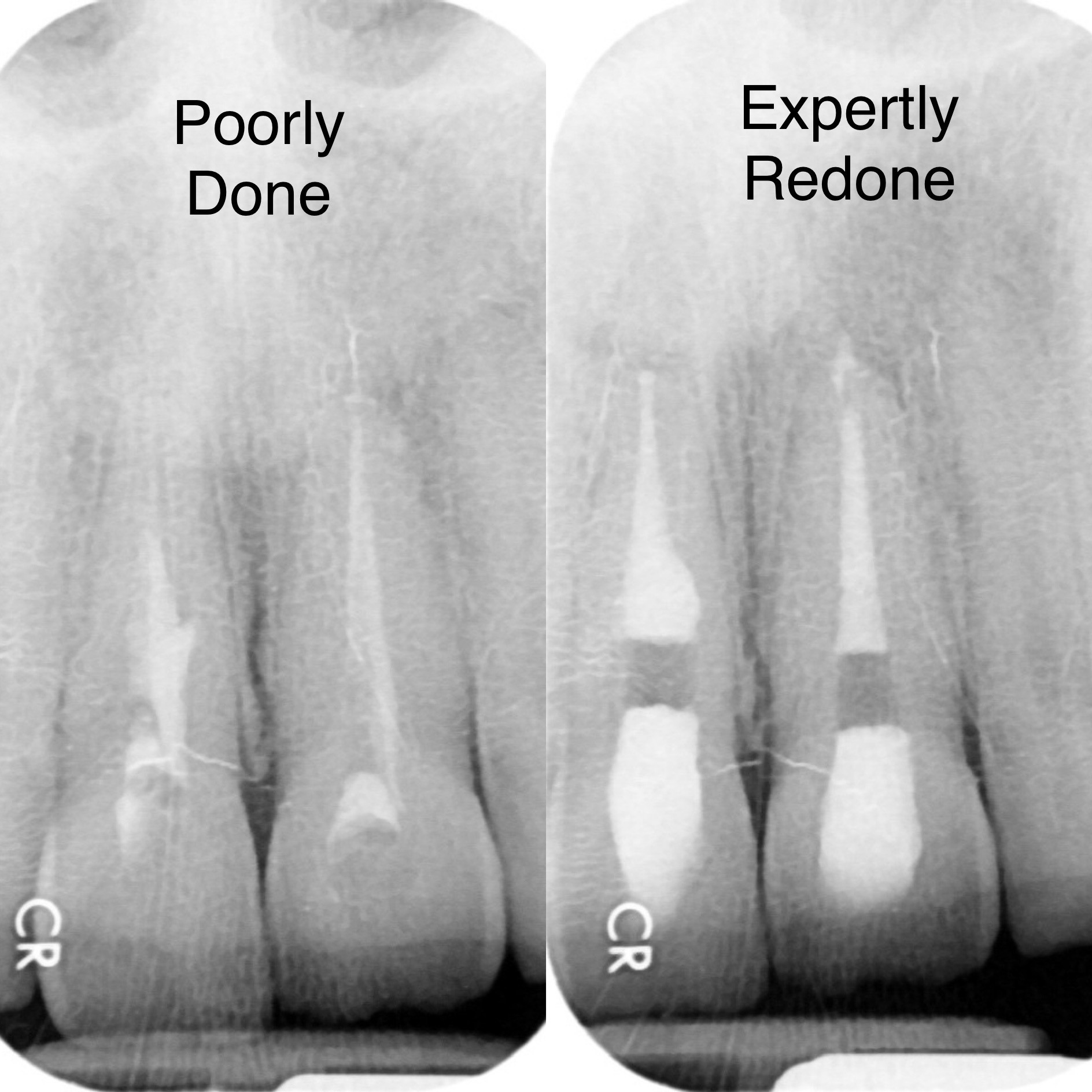 Root Canal Blog