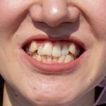 picture of a smile with crooked teeth