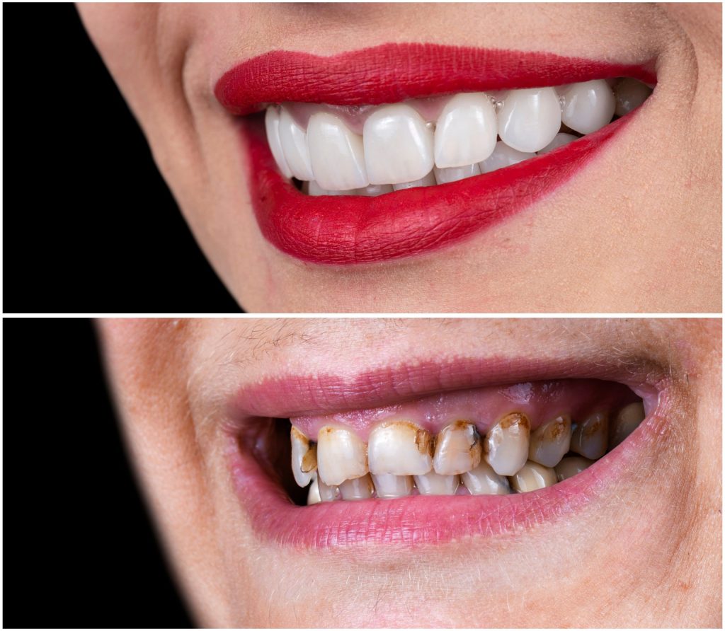 Chipped Teeth repair in London Ontario - London Ontario Dental Clinic