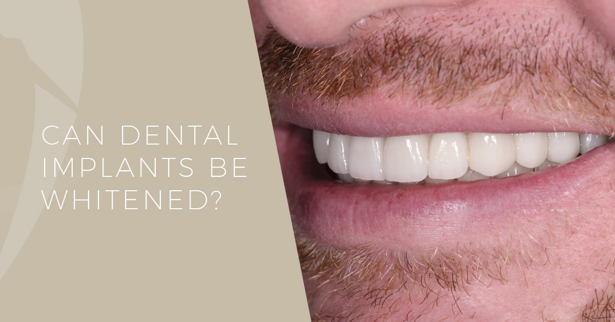 Can Dental Implants be Whitened?