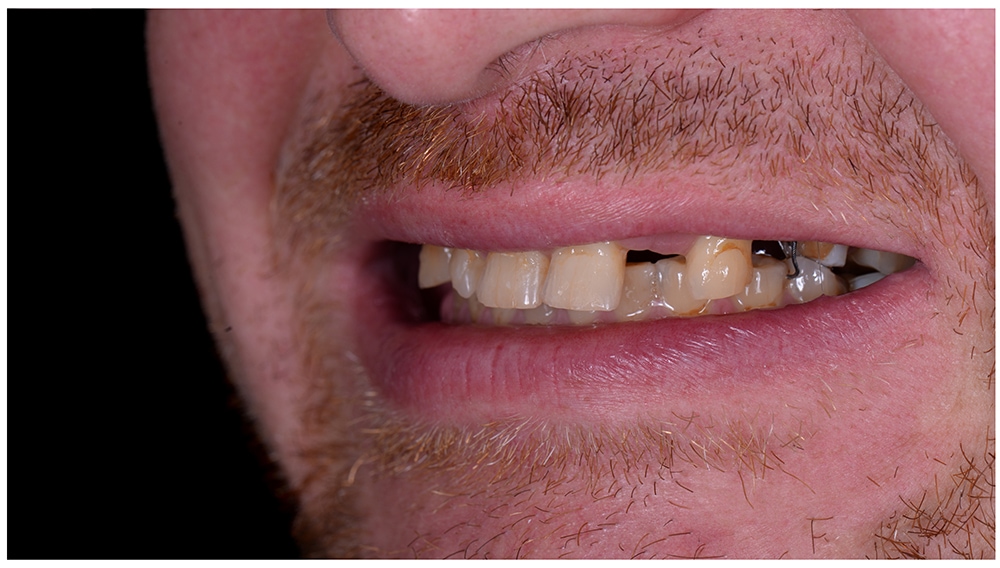 dental implant specialist dentist before whitening