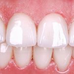 smile with porcelain veneers fitted