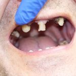 diabetes gum disease london