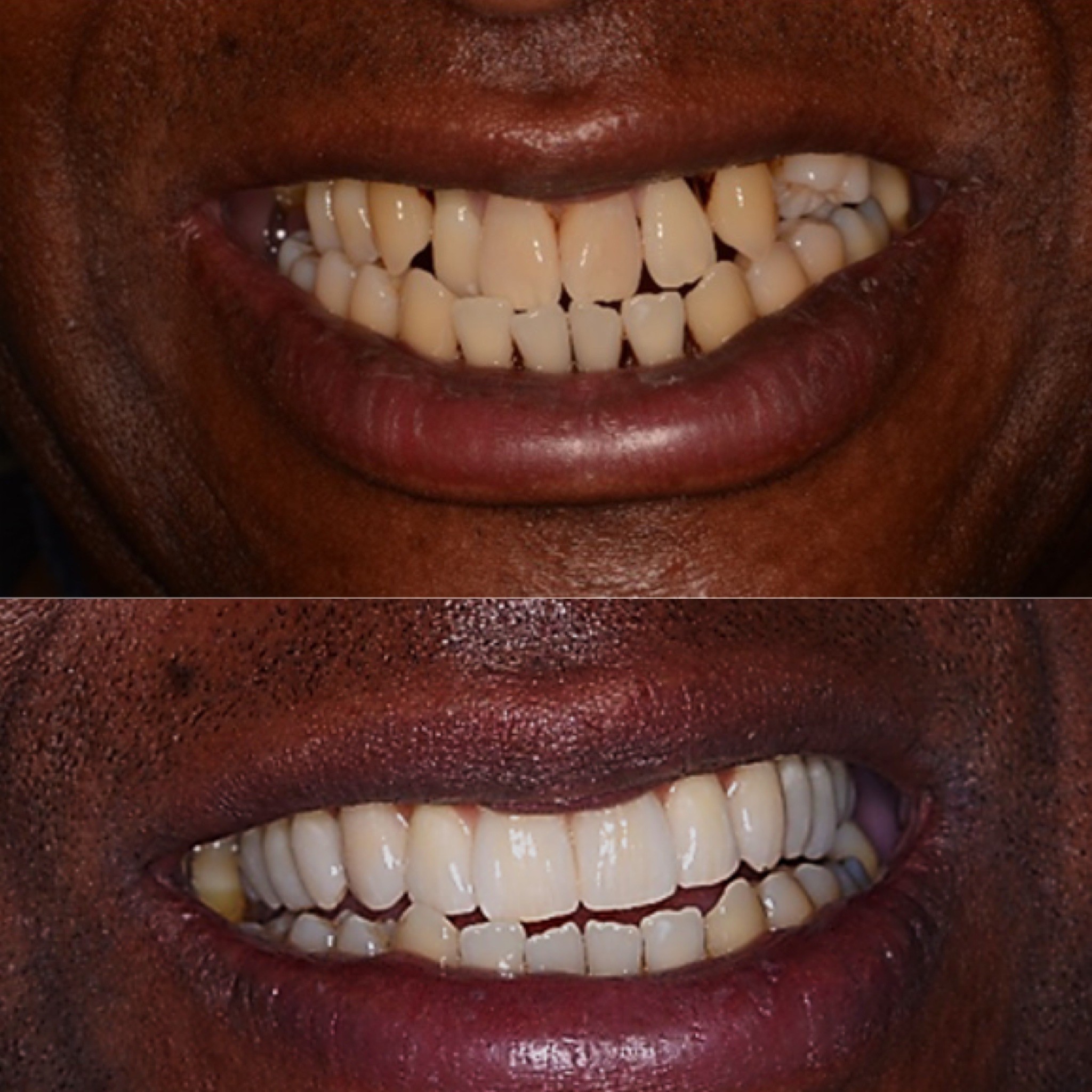 Dental Implants Are Life Changing