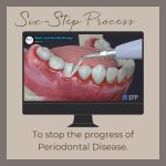 picture showing an ultrasonic scaler placed on teeth with the caption "to stop the progress of periodontal disease"