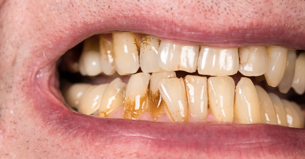 Why are my teeth stained?