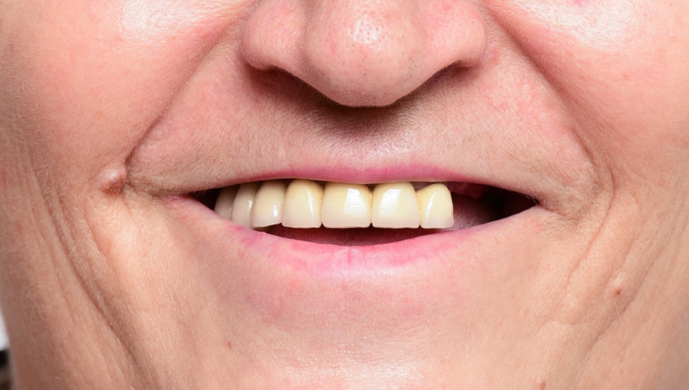 AllOn4 Walworth London 1 Dentist