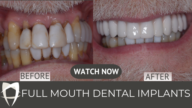 Full Mouth Implants | All-on-4 | Smile in a Day | Southgate