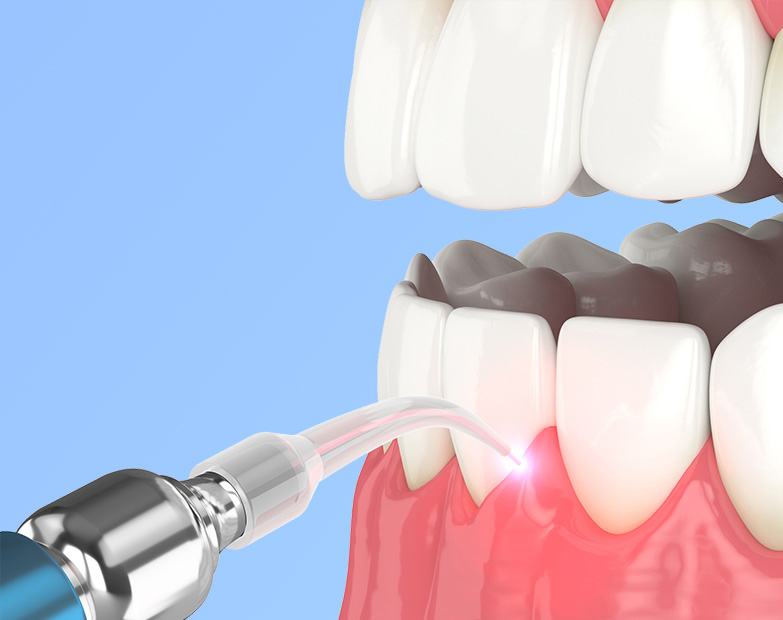 An example image of a Dental Laser and how it is used for General Dentistry. The dental laser being used on the teeth, with a blue background