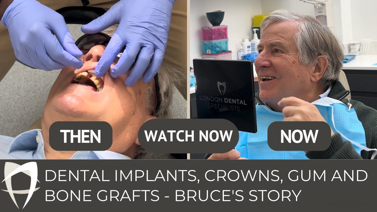 Dental Implants Gum Grafts & Dental Bone Grafts | Bruce's Story