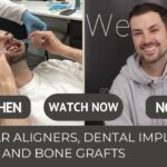 Mathew before and after dental implant invisalign, bone graft