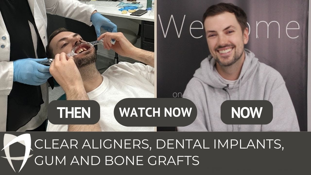 Clear Aligners, Gum & Bone Grafts and Dental Implants: Mathew's Smile Transformation