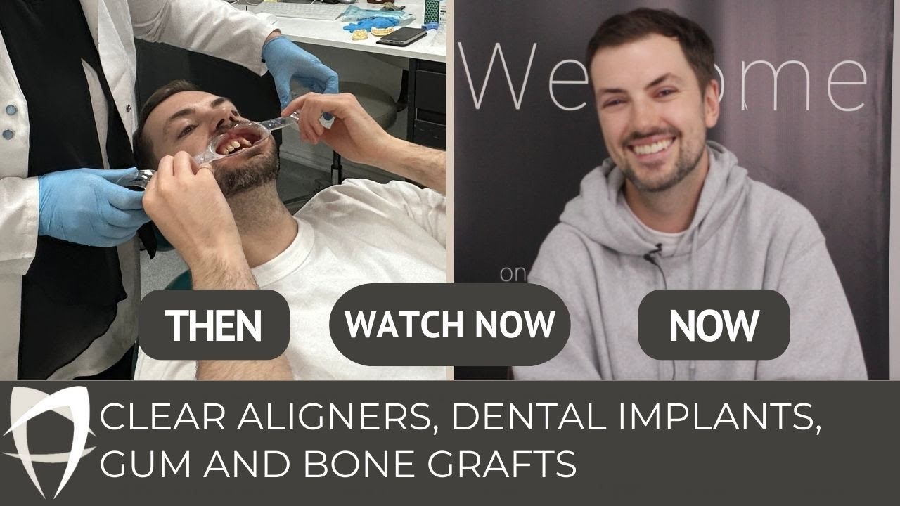 Clear Aligners Gum Bone Grafts And Dental Implants Mathew s Smile 