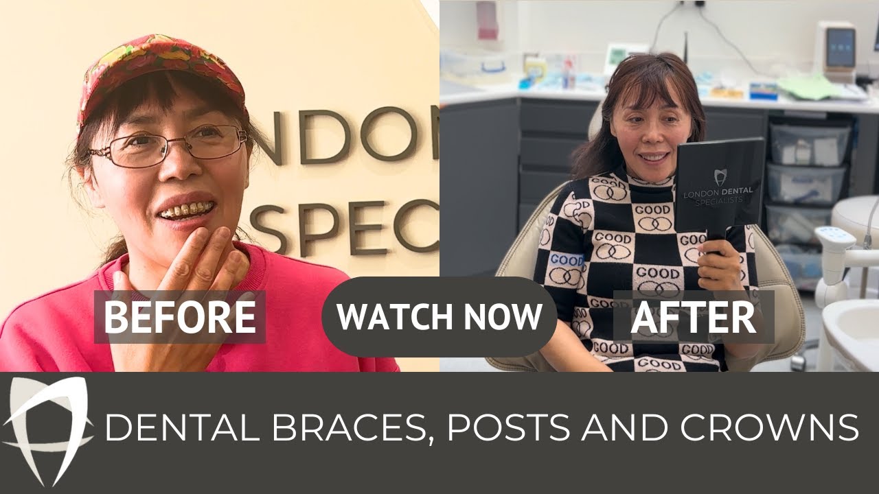 Understanding Dental Braces, Dental Post and Core and Dental Crowns: Anna Huang's Journey