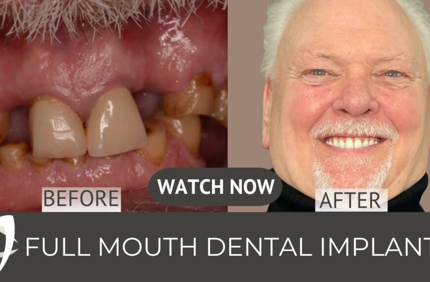 All-on-4 before and after Robert Luke smiling