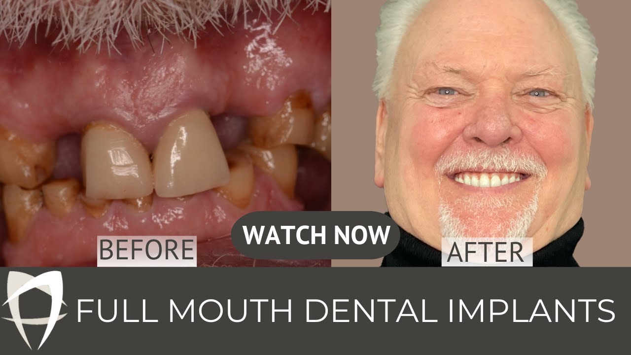 Robert Luke's Experience with Our All-on-4 and Full Mouth Dental Implants