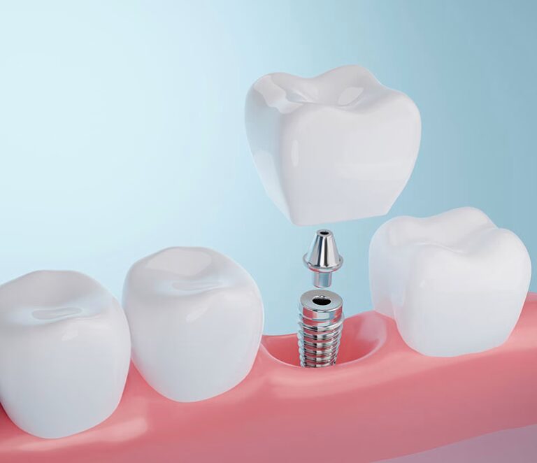 All-on-4® Dental Implants care for Belsize Park residents