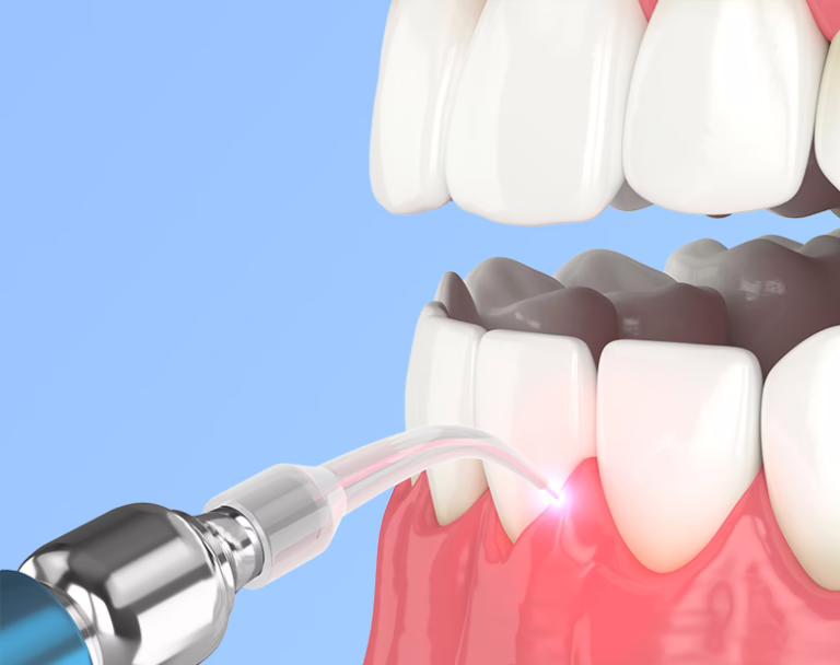 Peri-Implantitis Treatment services for Hanwell residents