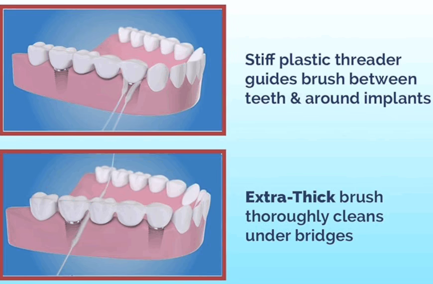 Proxy floss for dental implants and braces