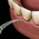 Lanap (laser assisted new attachment procedure) in london uk