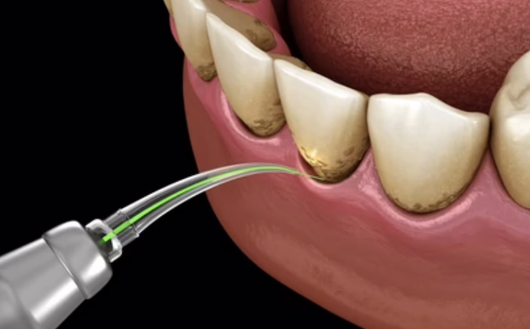 Is LANAP Suitable for Gum Disease Treatment?