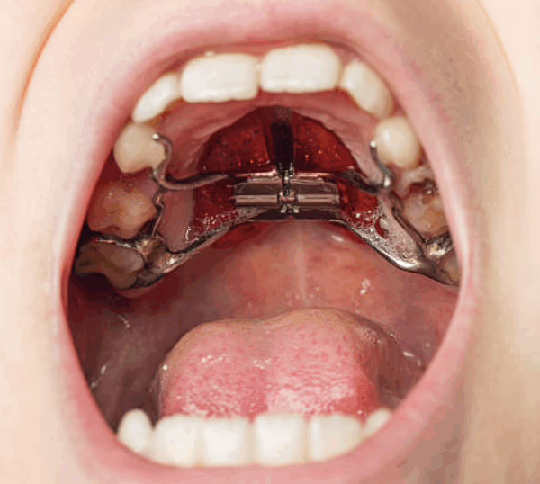 Palatal expander in london uk