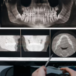 Wisdom teeth treatment in london uk