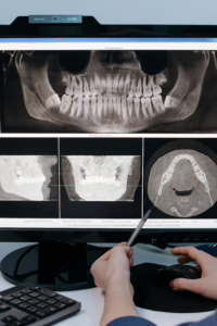 Can an Impacted Wisdom Tooth Affect Your Hearing?