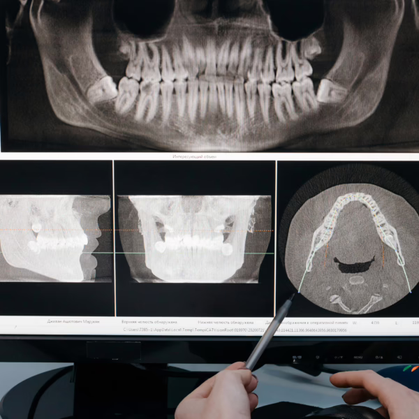 Wisdom teeth treatment in london uk