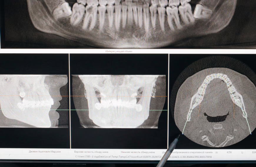 Wisdom teeth treatment in london uk