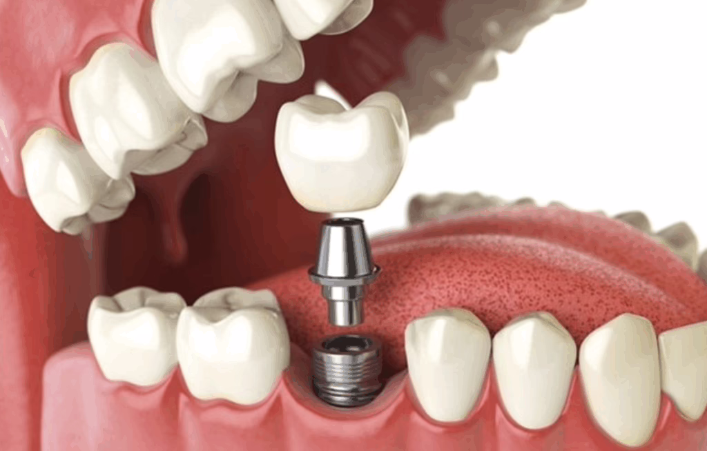 Should Implants Be Cleaned Before Crown Placement?