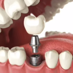 Dental implant in london uk 3