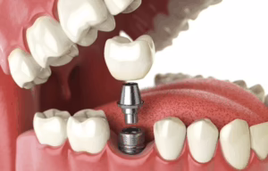 Should Implants Be Cleaned Before Crown Placement?