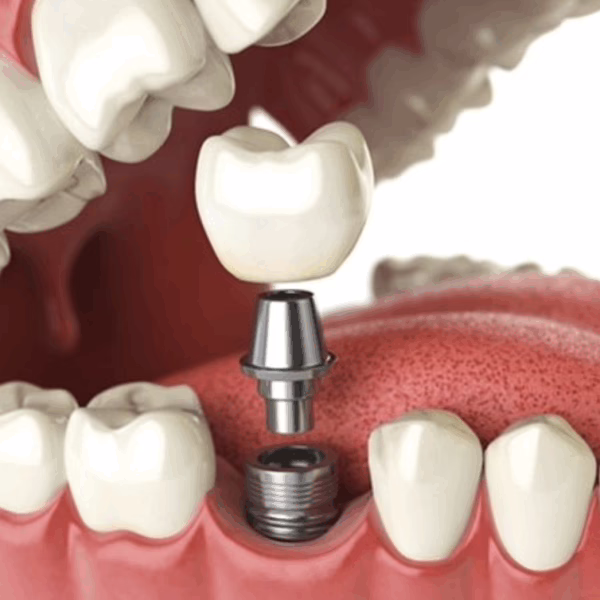 Dental implant in london uk 3