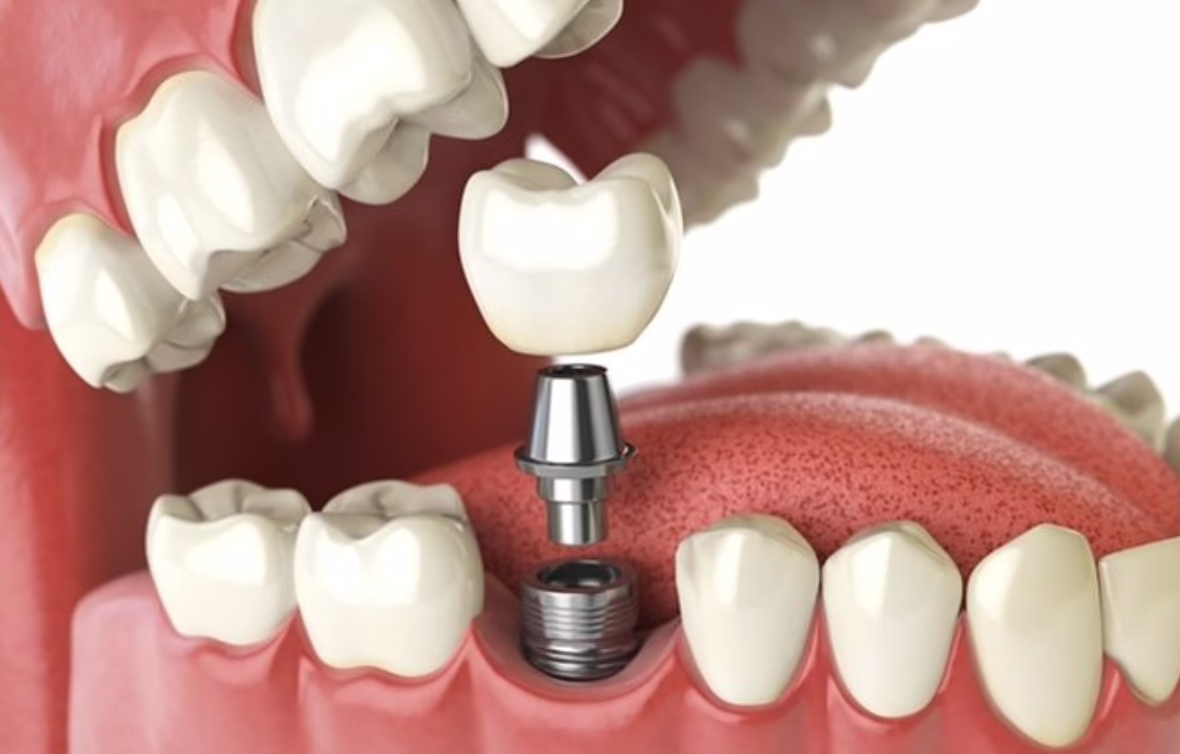 Should Implants Be Cleaned Before Crown Placement?