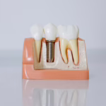 Dental infection treatment in london uk