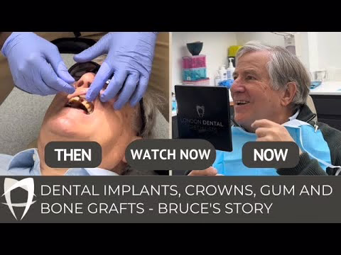Bruce's dental implant, crown and bone graft story