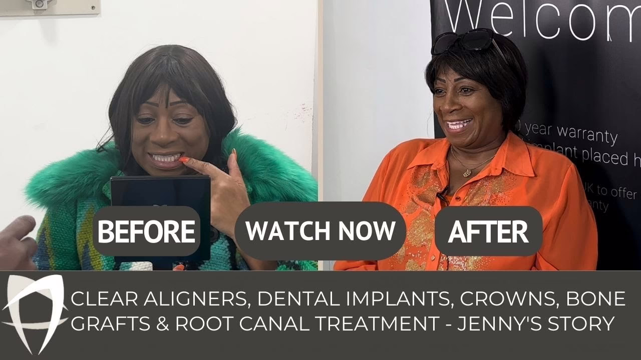 Jenny's clear aligners, implants, crowns and bone grafts story, before and after