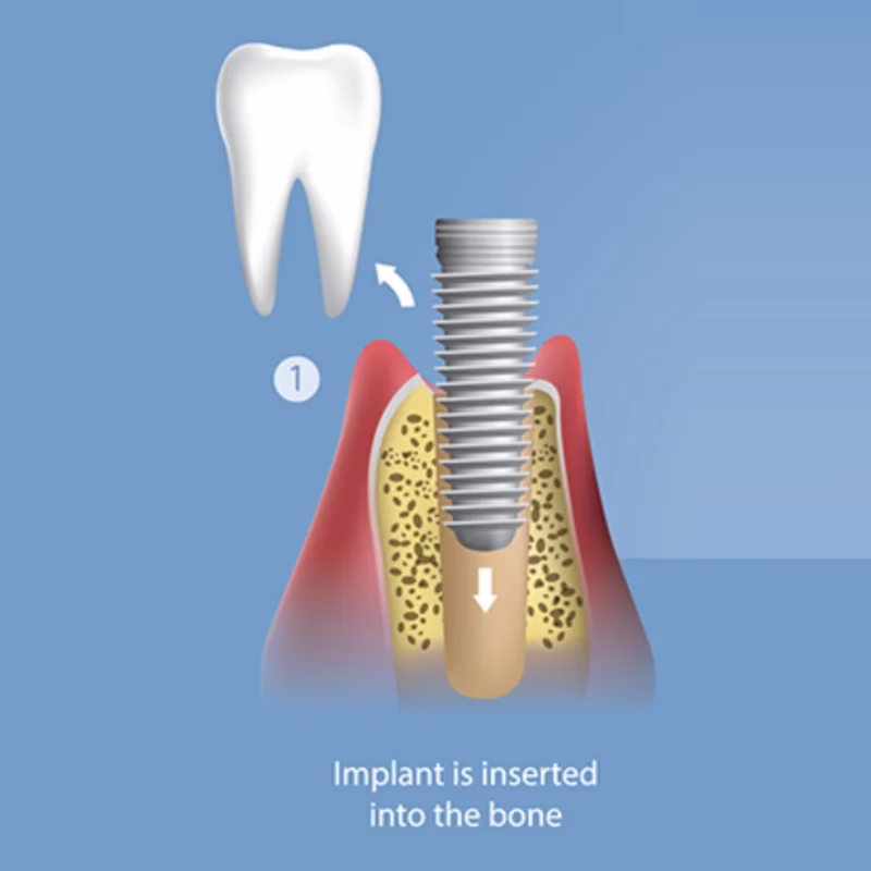 Step 1: the implant is inserted into the bone