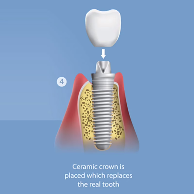Step 4: the ceramic crown is placed, replacing the real tooth
