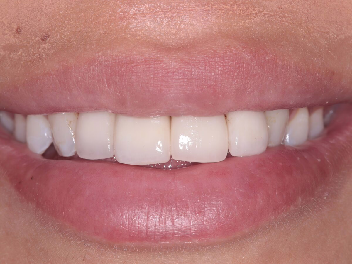 After dental implant treatment, case 1: a discoloured, uneven front tooth restored to an even, natural smile