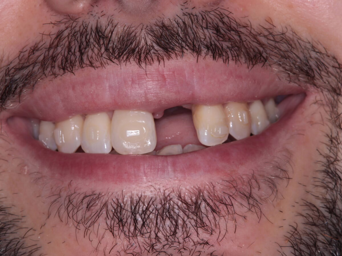 Before dental implant treatment, case 2