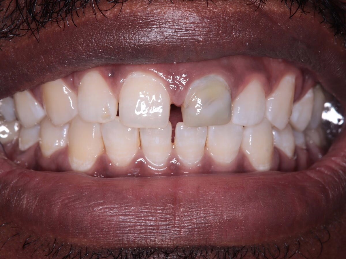 Before dental implant treatment, case 3